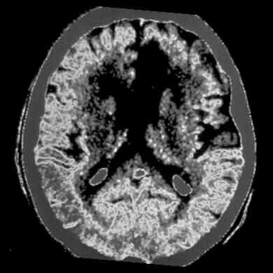 CT scan of the brain of a stroke patient. Dark areas indicate reduced activity.